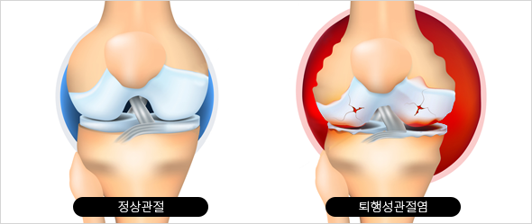 퇴행성관절염