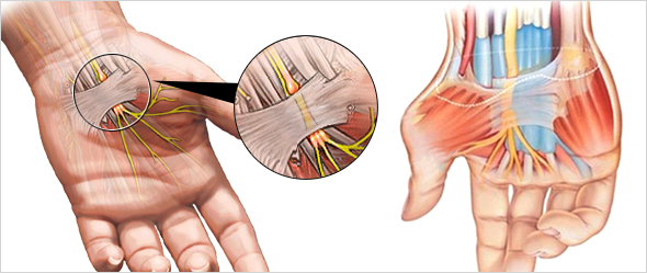 손목터널증후군