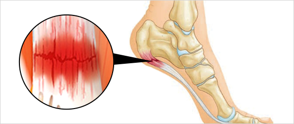 족저근막염